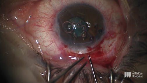Combined Surgery in the Eye of a Patient With Weill-Marchesani Syndrome